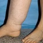 Rashtra Jagrookta | फाइलेरिया उन्मूलन • जिले में 10 अगस्त से चलेगा...