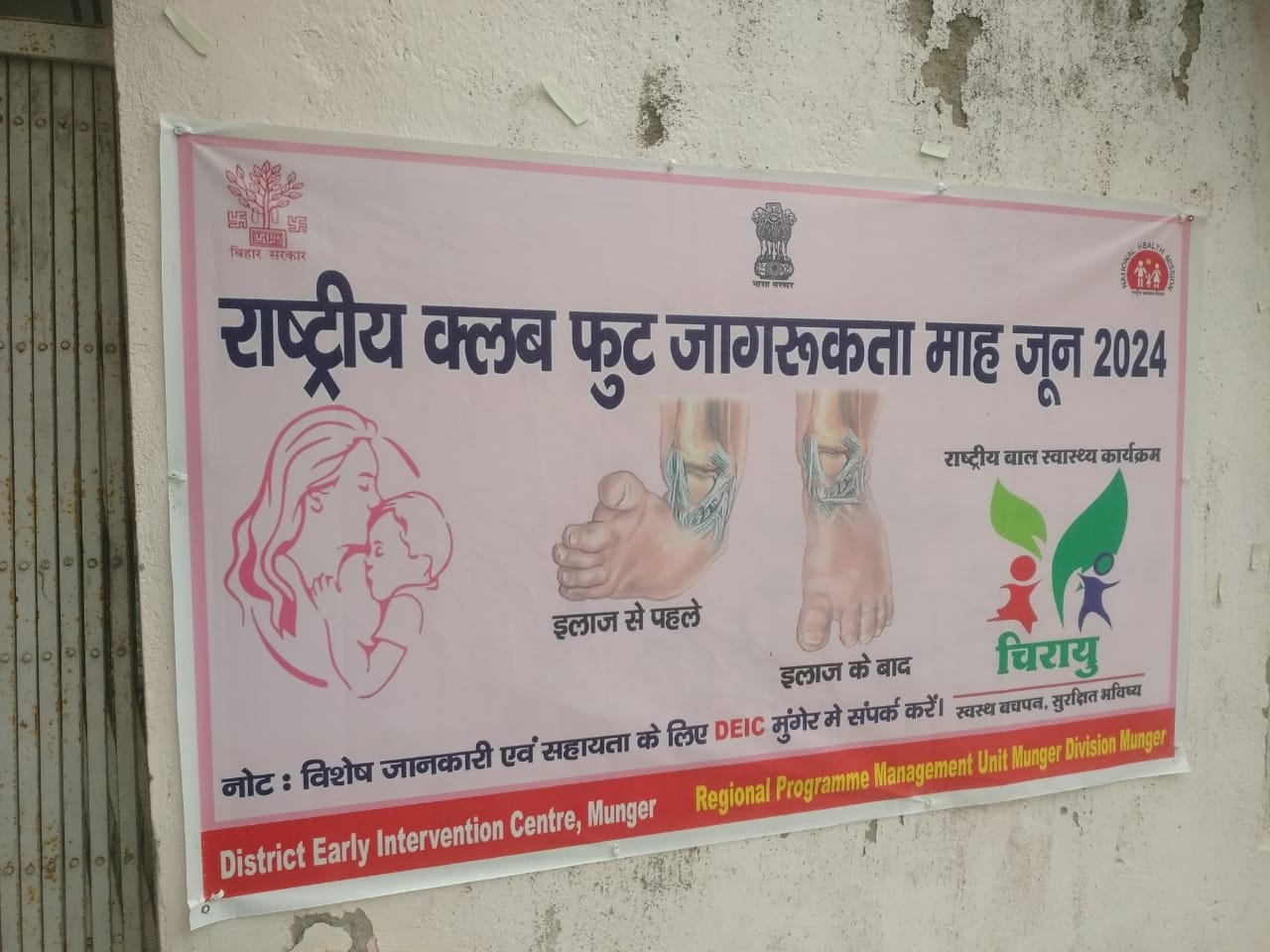 Rashtra Jagrookta | दो माह में क्लब फुट के 11 बच्चों की हुई पहचान, चल रहा इलाज